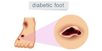 Diabetic Foot Treatment in Thrissur