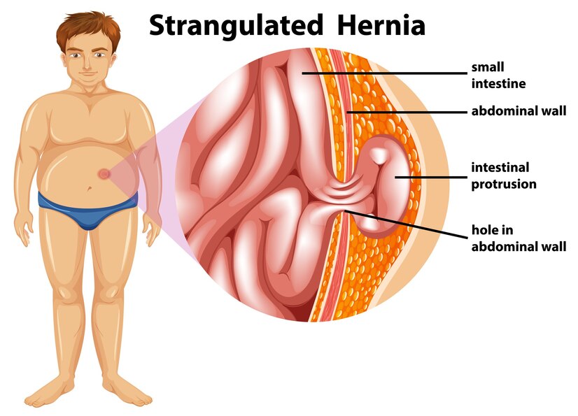 Hernia Treatment at Daya General Hospital