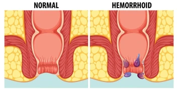 Piles Treatment at Daya General Hospital