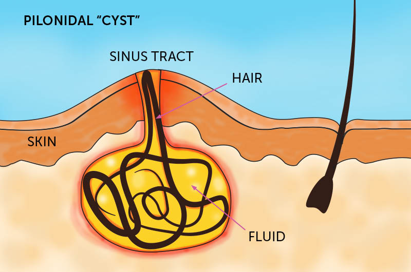 Pilonidal Sinus Treatment in Thrissur Kerala