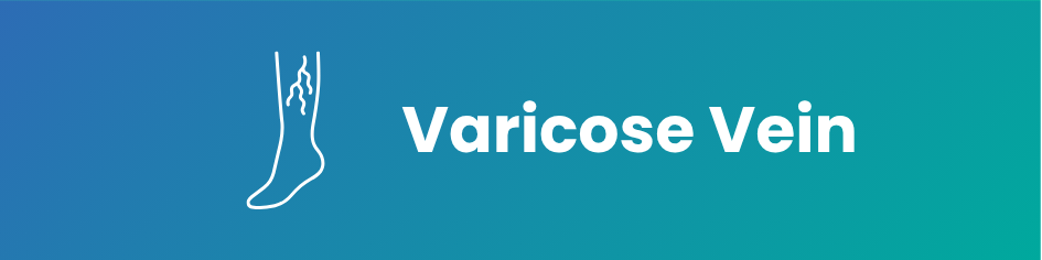 Varicose Vein Treatment